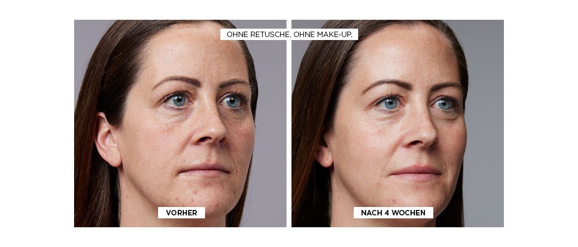 Vorher- und Nachhereffekte der Nutzung vom Revitalift Laser Nacht Serum